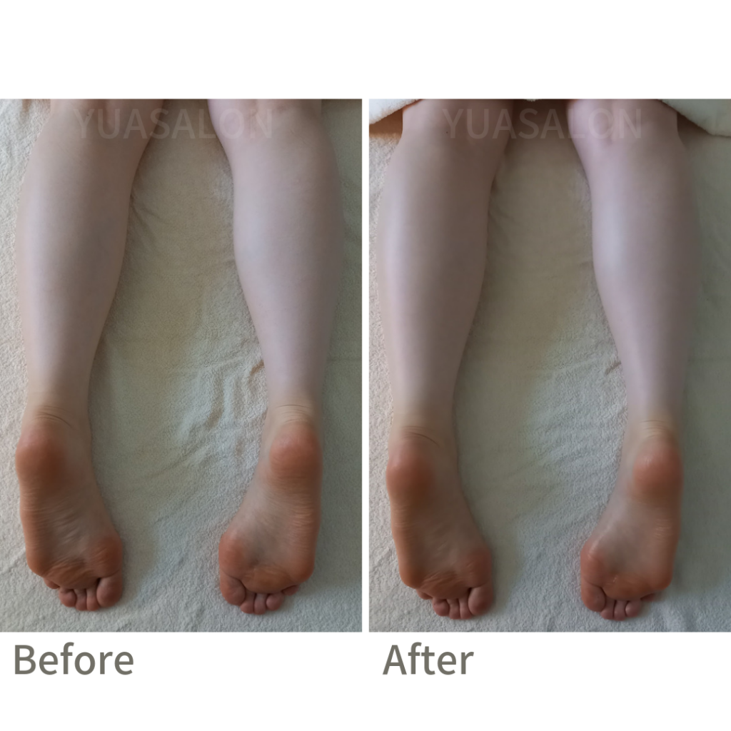 横浜 妊活 女性ホルモン むくみ改善